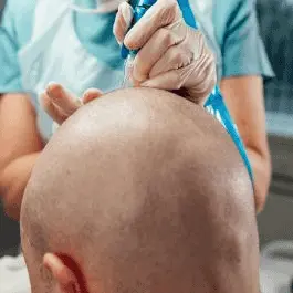 micropigmentación capilar bilbao