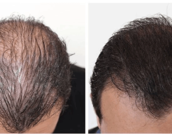 Redensificación Hombres